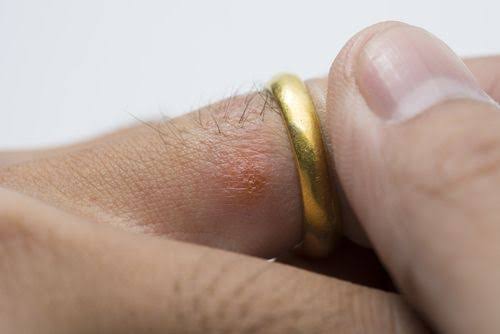 なぜ結婚指輪でアレルギーになるのか